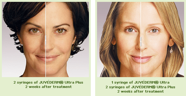 Juvederm results