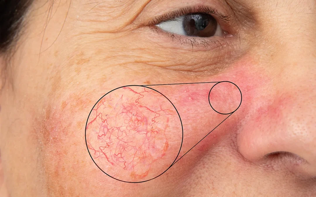 Best Treatment to Remove Facial Red Veins
