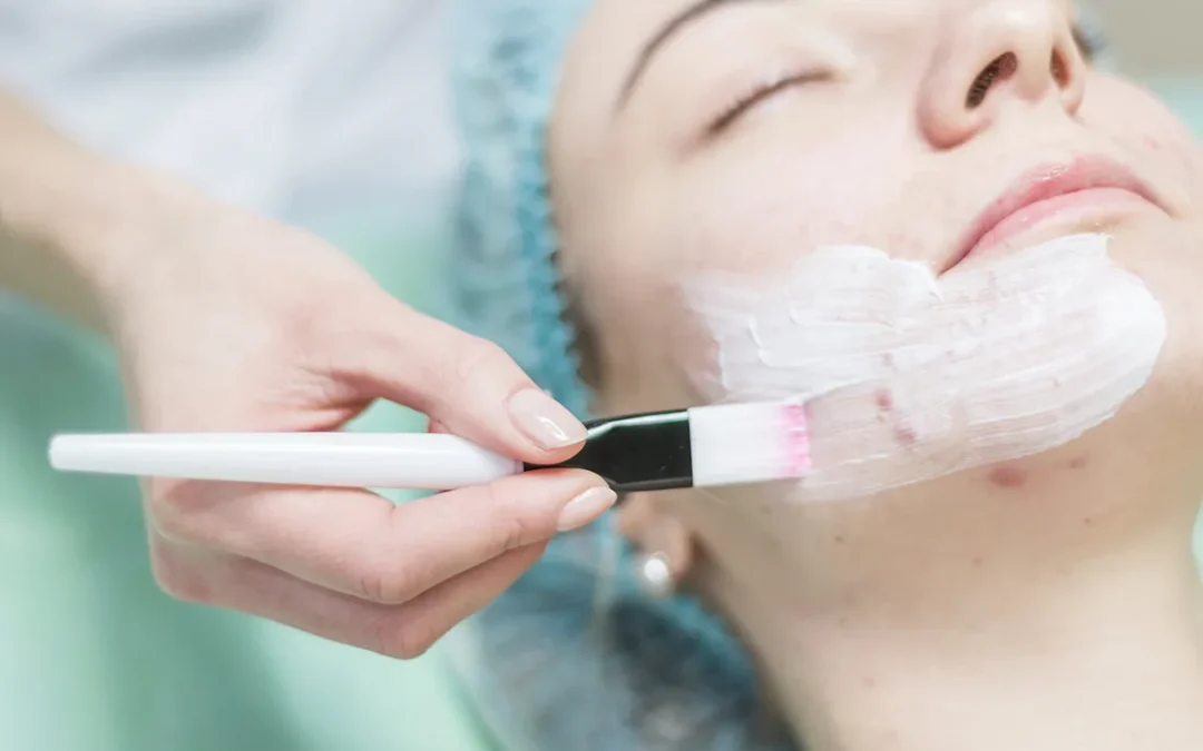 How to Get Rid of Acne Scars