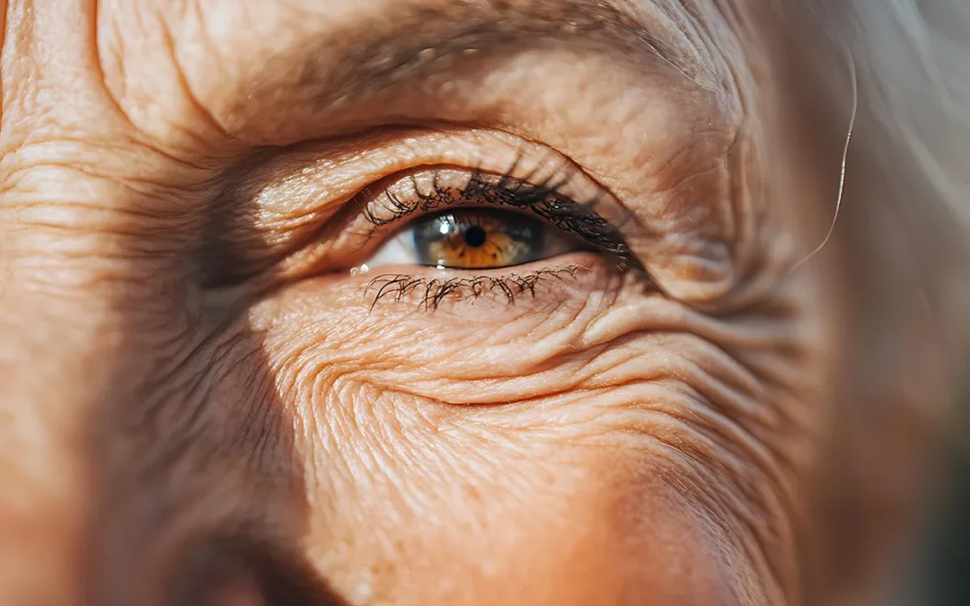 Ready To Treat Those Lines Around Your Eyes?