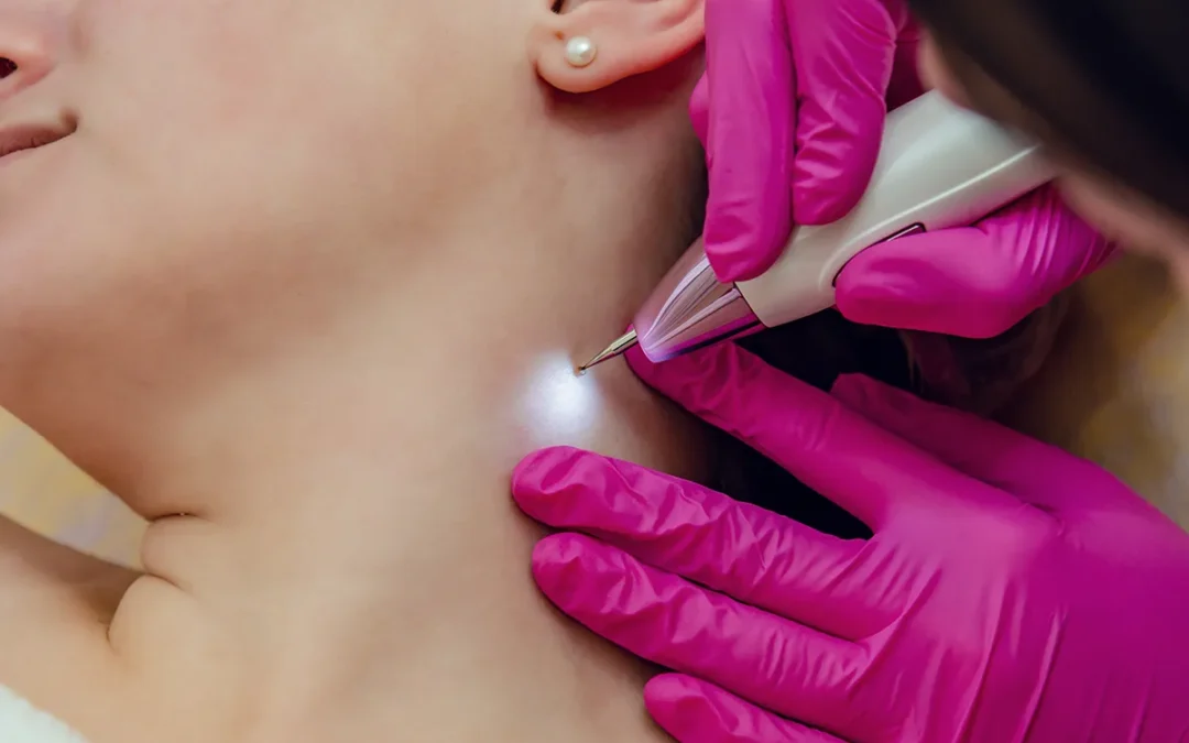 Skin Tags Removal Holly Springs