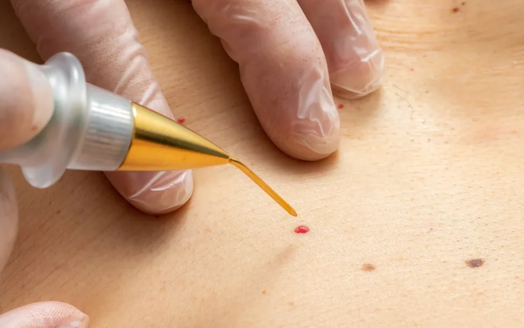Cherry Angioma Removal