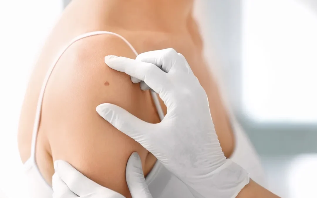 How Much Do You Know About Melanoma?