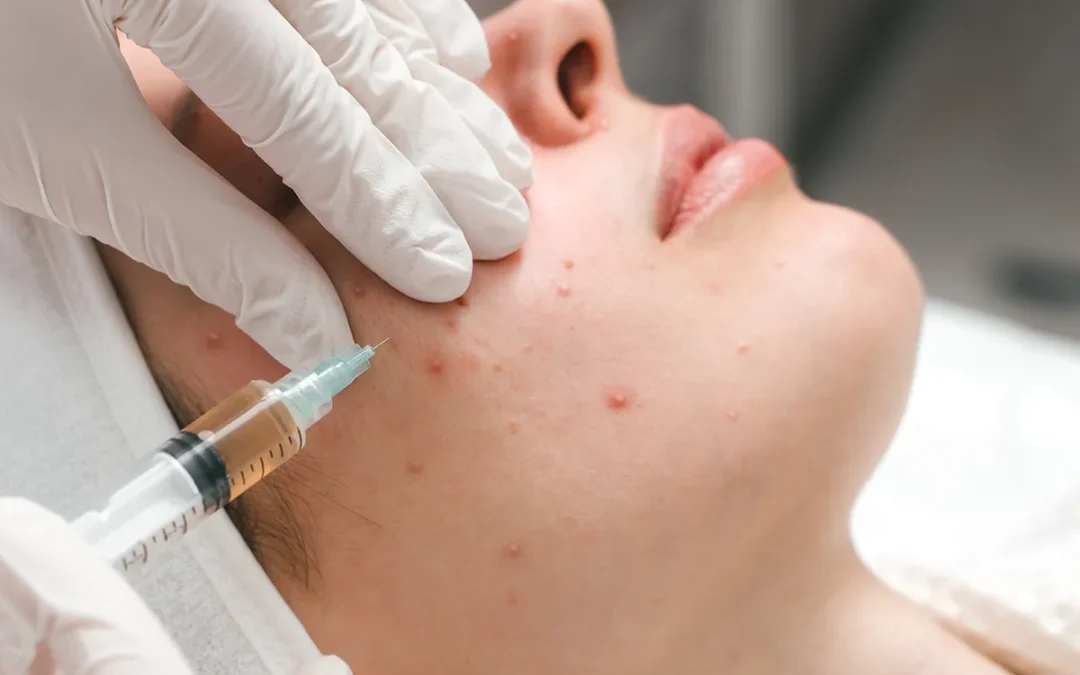Different Treatments For Different Types Of Acne Scars