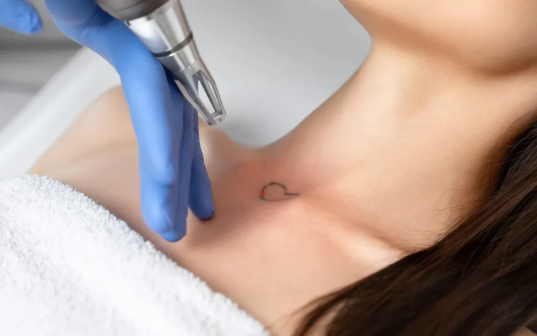 Tattoo Removal Dual Wavelength Technology