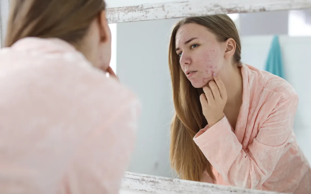 Acne Scars Treatment Recommended by Our Skin Specialists