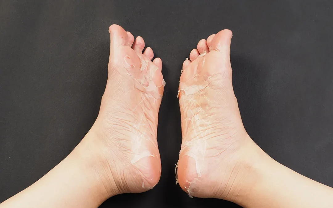 Baby Foot Exfoliating Foot Peel