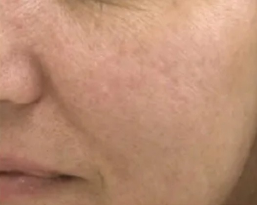 Non Invasive Laser Results - After Photo