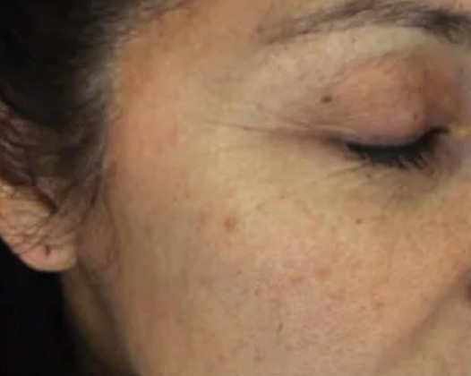 Micro Needling Results - After Photo