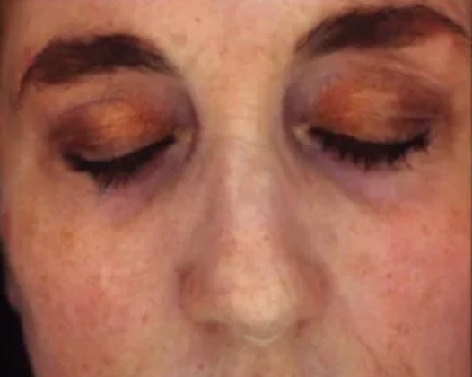 Micro Needling Results - Before Photo