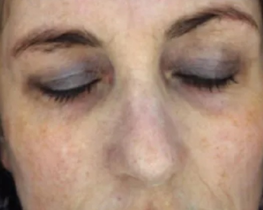 Micro Needling Results - After Photo