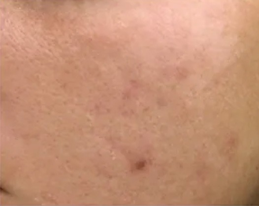 Chemical Peel Results - Before Photo