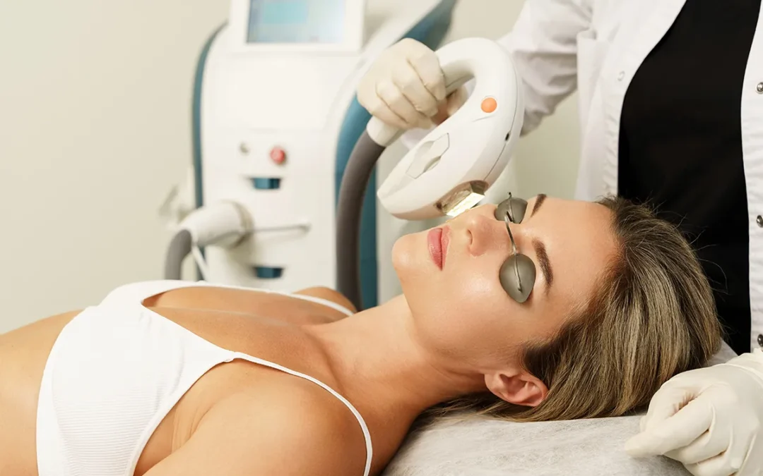 Exploring the Benefits of IPL for Rosacea Management
